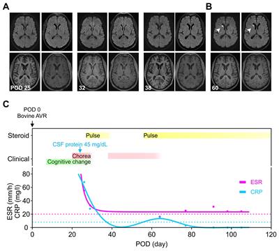 The known and unknown of post-pump chorea: a case report on robust steroid responsiveness implicating occult neuroinflammation